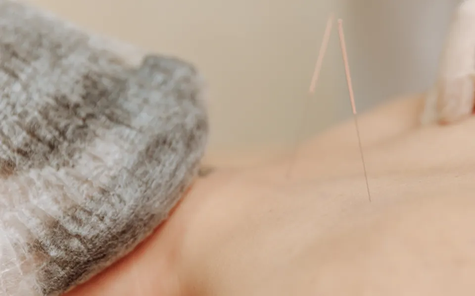 Fine dry needling needles placed along a patient's back