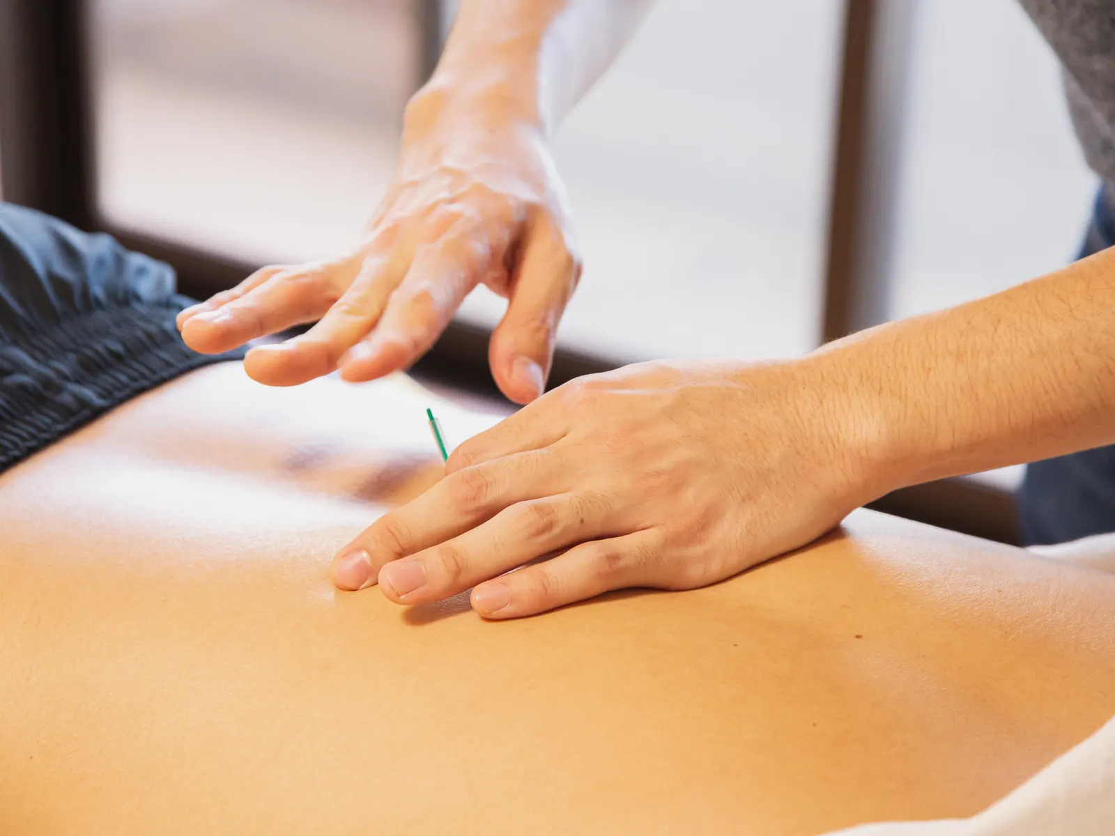 Practitioner placing fine dry needling needles along a patient's back